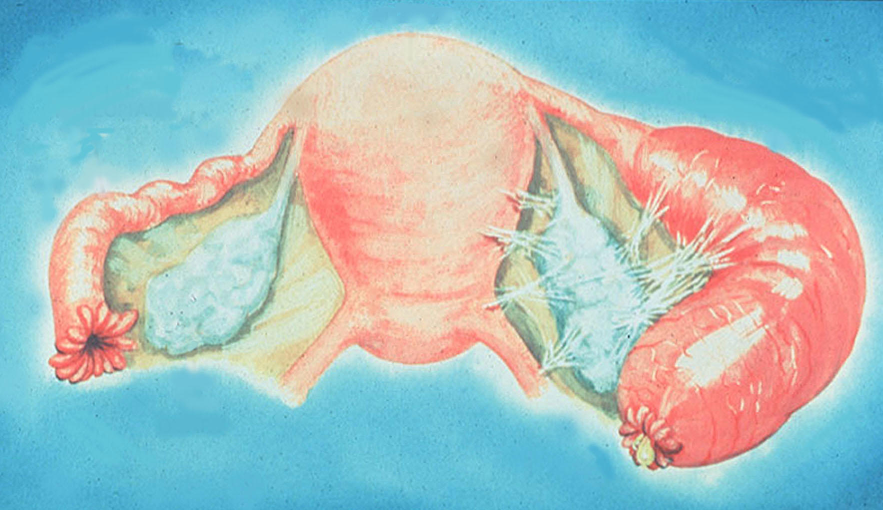 Pelvic Inflammatory Disease (PID)